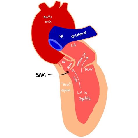 what is lvot gradient